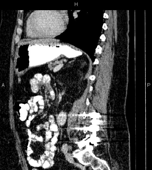 Adrenal myelolipoma (Radiopaedia 84319-99617 Sagittal renal cortical phase 59).jpg