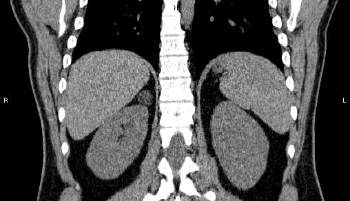 Adrenal myelolipoma (Radiopaedia 84321-99619 Coronal non-contrast 58).jpg