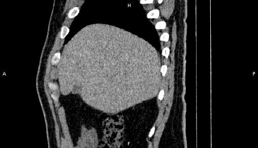 Adrenal myelolipoma (Radiopaedia 84321-99619 Sagittal non-contrast 18).jpg
