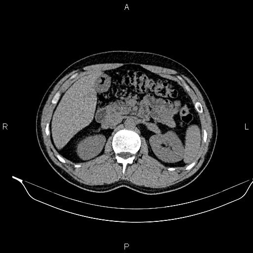 Adrenal myelolipoma (Radiopaedia 87794-104246 Axial non-contrast 40).jpg
