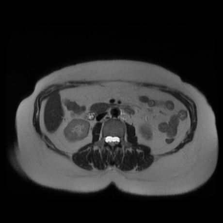 File:Adrenal myelolipoma - MRI (Radiopaedia 83249-97646 Axial T2 24).jpg