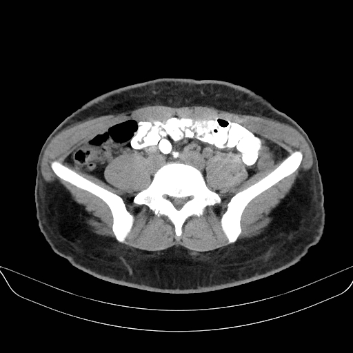 Adrenal myelolipoma - bilateral (Radiopaedia 74805-85810 Axial non-contrast 54).jpg