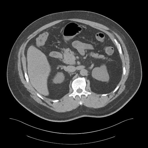 File:Adrenal vein sampling and adrenal nodular hyperplasia - Conn syndrome (Radiopaedia 30561-31337 Axial non-contrast 29).jpg