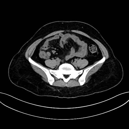 Adrenocortical carcinoma (Radiopaedia 87281-103569 Axial non-contrast 62).jpg