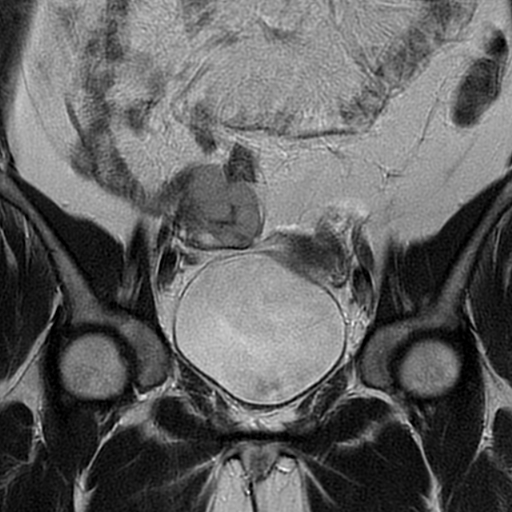 File:Adult granulosa cell tumor of the ovary (Radiopaedia 64991-73953 Coronal T2 8).jpg