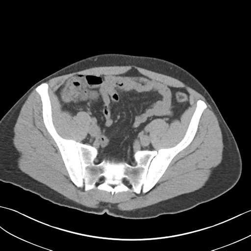 File:Adult polycystic kidney disease (Radiopaedia 47866-52626 Axial non-contrast 64).png