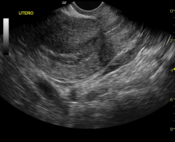 File:Advanced ectopic pregnancy (Radiopaedia 12862-12983 Longitudinal 1).jpg