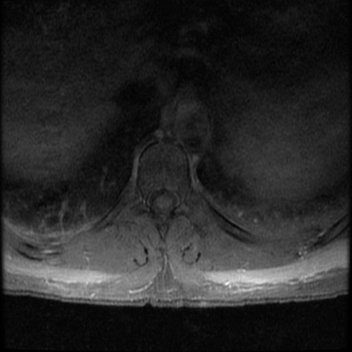 File:Aggressive vertebral hemangioma (Radiopaedia 39937-42404 Axial T1 C+ fat sat 13).png
