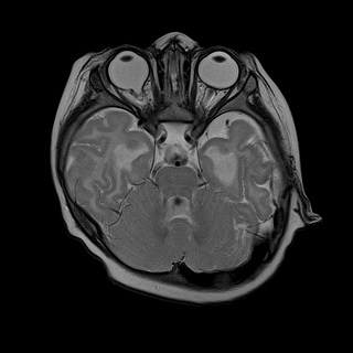 File:Aicardi syndrome (Radiopaedia 66029-75205 Sagittal T1 2).jpg