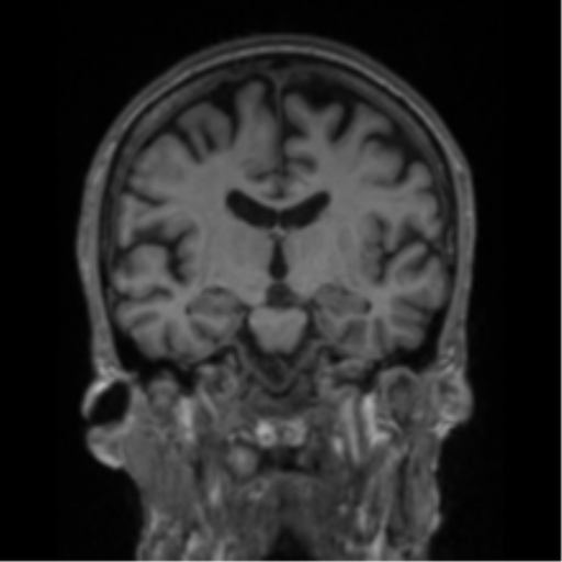 File:Alzheimer's disease- with apraxia (Radiopaedia 54763-61011 Coronal T1 50).png