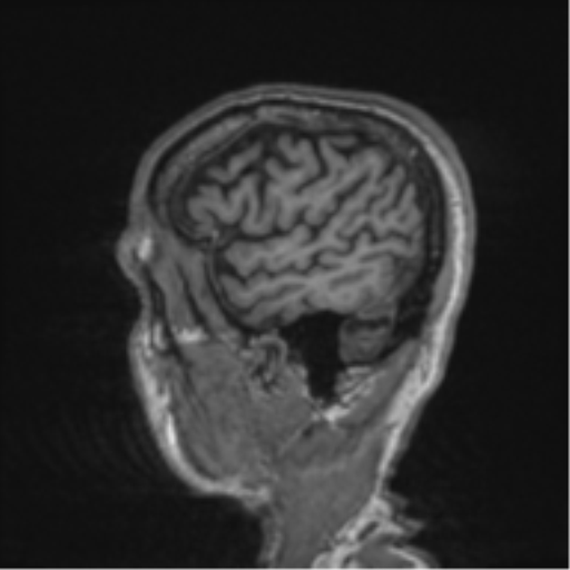 File:Alzheimer's disease- with apraxia (Radiopaedia 54763-61011 Sagittal T1 61).png
