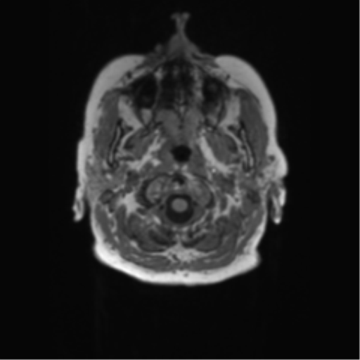 File:Alzheimer's disease (Radiopaedia 42658-45802 Axial T1 146).png