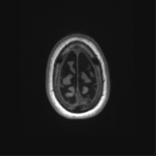 Alzheimer's disease (Radiopaedia 42658-45802 Axial T1 20).png