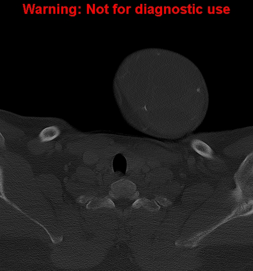 Ameloblastoma (Radiopaedia 33126-34164 Axial bone window 41).jpg