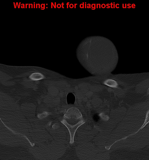 Ameloblastoma (Radiopaedia 33126-34164 Axial bone window 45).jpg