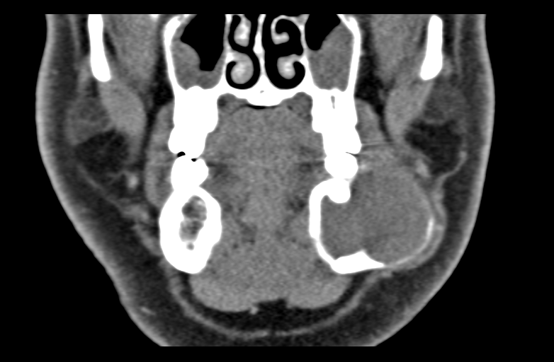 Ameloblastoma (Radiopaedia 33677-34806 Coronal non-contrast 24).png