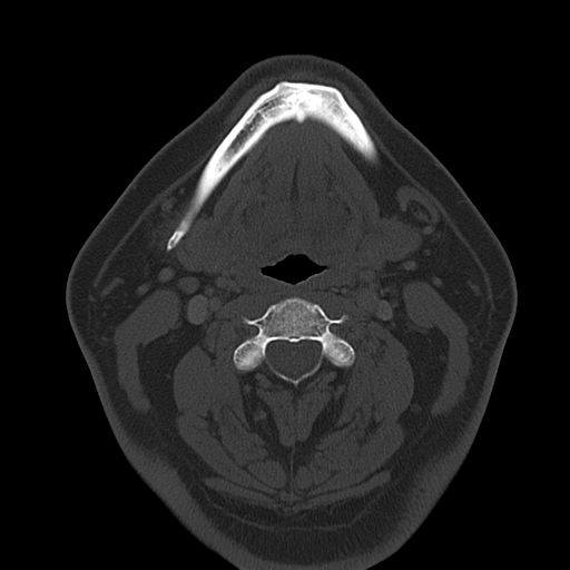File:Ameloblastoma (Radiopaedia 38520-40623 Axial bone window 37).png
