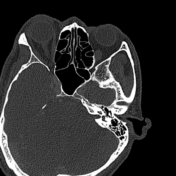 Ameloblastoma (Radiopaedia 51921-57766 Axial bone window 167).jpg