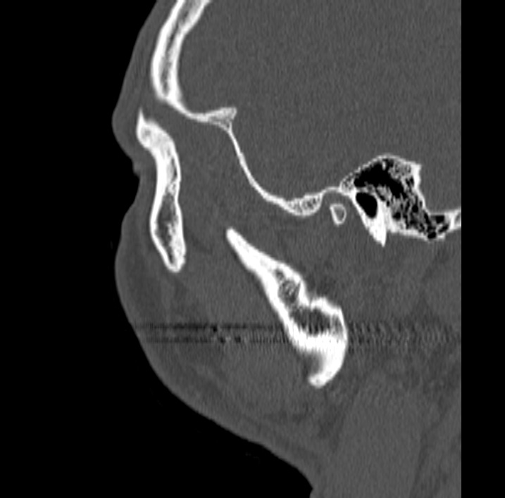 Ameloblastoma (Radiopaedia 77750-89997 Sagittal bone window 106).jpg