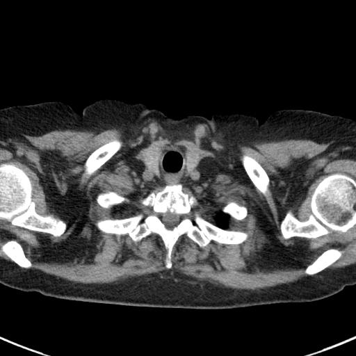 File:Amiodarone-induced pulmonary fibrosis (Radiopaedia 82355-96460 Axial non-contrast 7).jpg