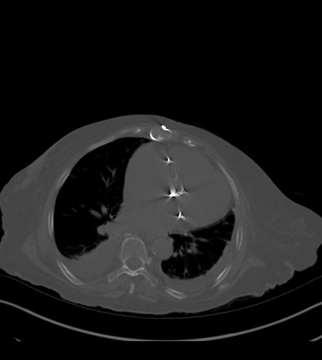 Amiodarone deposition in the liver (Radiopaedia 77587-89780 Axial bone window 52).jpg
