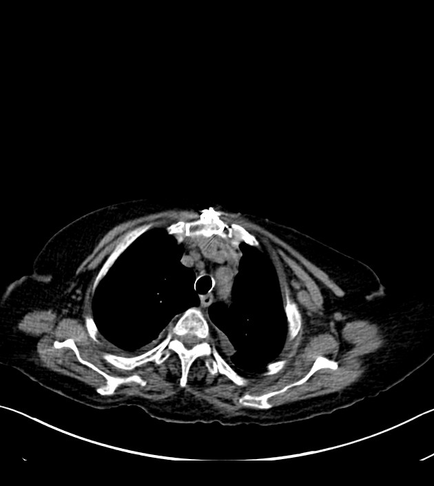 Amiodarone deposition in the liver (Radiopaedia 77587-89780 Axial non-contrast 18).jpg