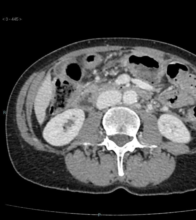 Ampulla of Vater metastasis (Radiopaedia 27820-28065 A 49).jpg