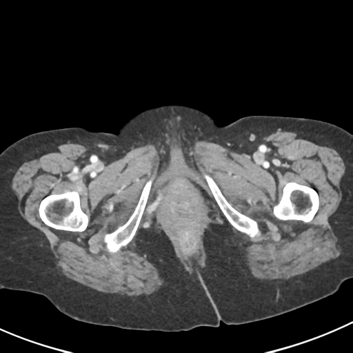 Ampullary adenocarcinoma (Radiopaedia 34013-35237 C 63).png