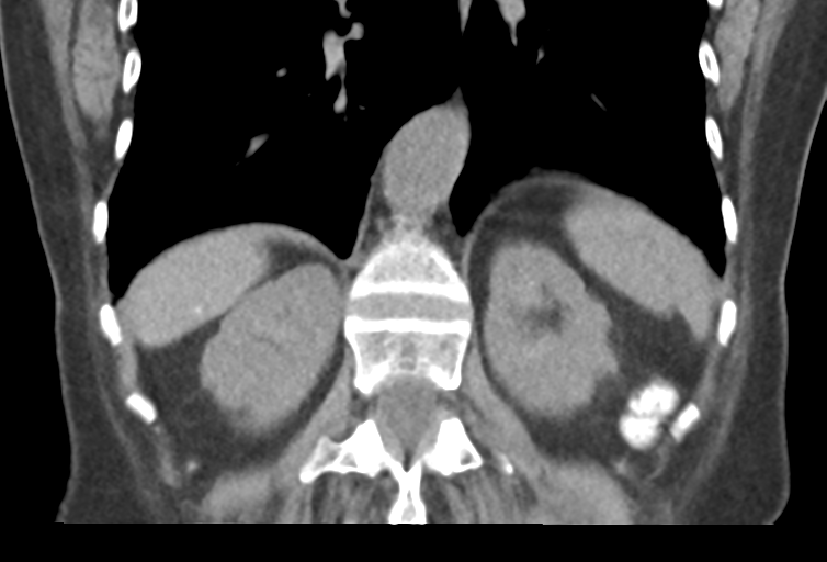 Ampullary adenocarcinoma (Radiopaedia 34013-35241 Coronal 37).png