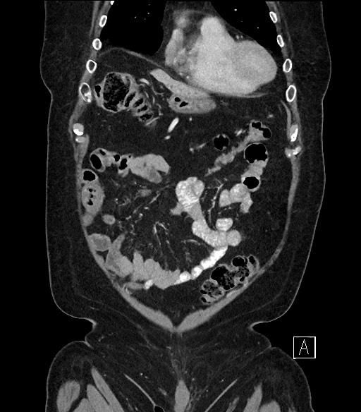 Ampullary adenocarcinoma (Radiopaedia 59373-66734 D 17).jpg
