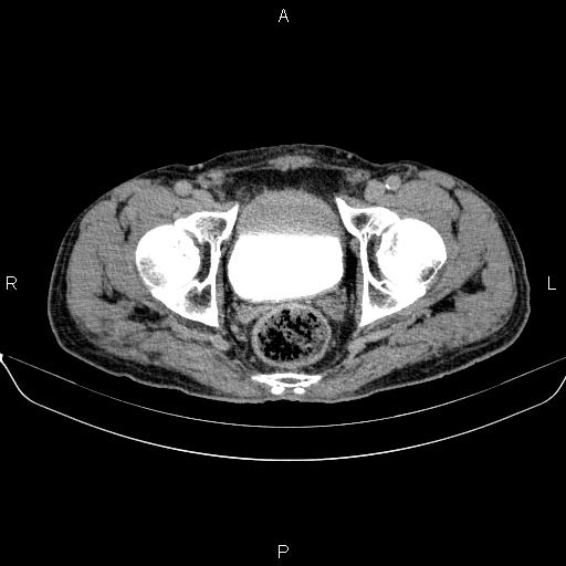 Ampullary adenocarcinoma (Radiopaedia 86093-102032 Axial C+ delayed 98).jpg
