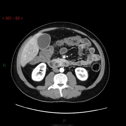 File:Ampullary carcinoma (Radiopaedia 56396-63056 B 39).jpg