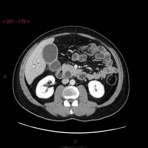 Ampullary carcinoma (Radiopaedia 56396-63056 C 46).jpg