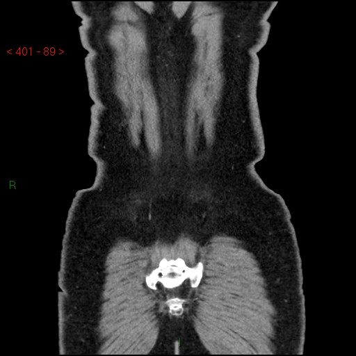 Ampullary carcinoma (Radiopaedia 56396-63056 E 88).jpg