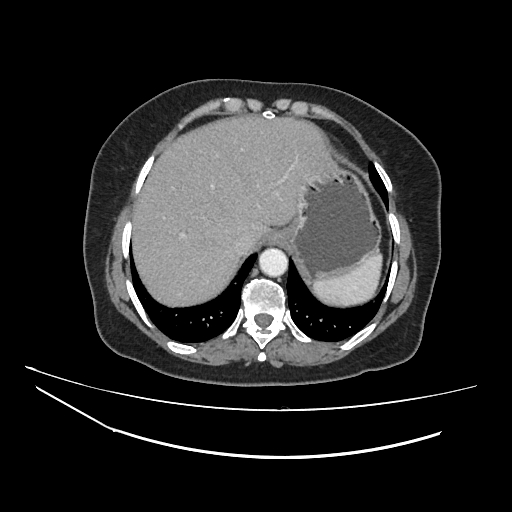 Ampullary tumor (Radiopaedia 60333-67998 A 6).jpg