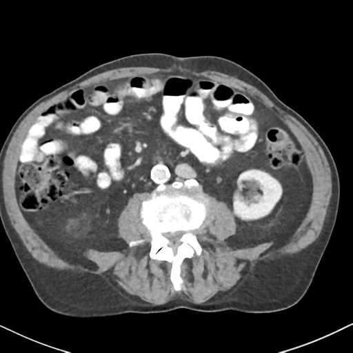 File:Amyand hernia (Radiopaedia 39300-41547 A 36).png