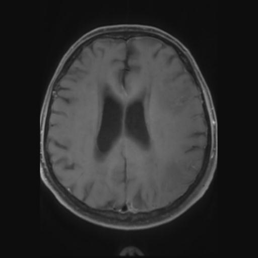 File:Amyloid angiopathy with inflammation (Radiopaedia 30360-31002 Axial T1 C+ fat sat 21).jpg