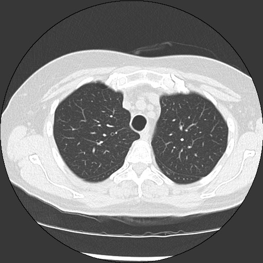 Amyloidosis - bronchial and diffuse nodular pulmonary involvement (Radiopaedia 60156-67744 B 15).jpg