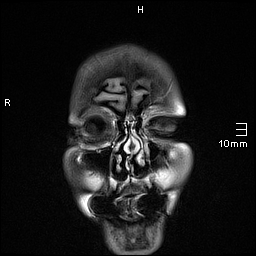File:Amyotrophic lateral sclerosis (Radiopaedia 70821-81017 Coronal FLAIR 3).jpg