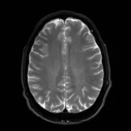 File:Amyotrophic lateral sclerosis (Radiopaedia 87352-103658 Axial DWI 19).jpg