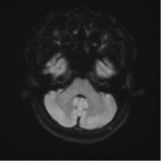 Anaplastic astroblastoma (Radiopaedia 55666-62194 Axial DWI 35).png