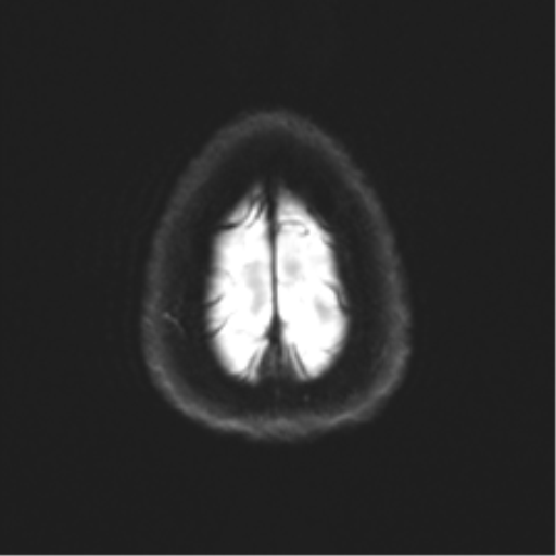Anaplastic astrocytoma - thalamic glioma (Radiopaedia 59709-67115 Axial DWI 33).png