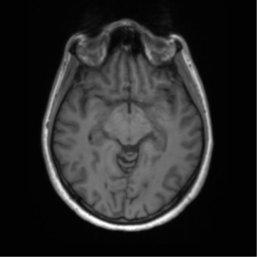 File:Anaplastic astrocytoma - thalamic glioma (Radiopaedia 59709-67115 Axial T1 9).png