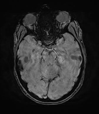 File:Anaplastic astrocytoma IDH mutant (Radiopaedia 50046-55341 Axial SWI 33).png