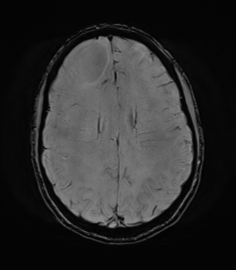 File:Anaplastic astrocytoma IDH mutant (Radiopaedia 50046-55341 Axial SWI 59).png