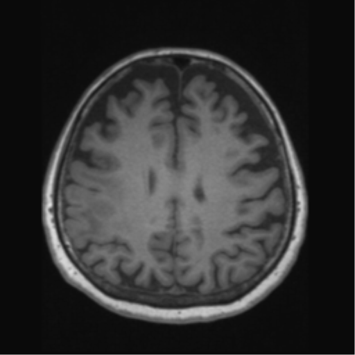 Anaplastic astrocytoma IDH wild-type (pseudoprogression) (Radiopaedia 42209-45276 Axial T1 102).png