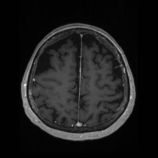 File:Anaplastic astrocytoma IDH wild-type (pseudoprogression) (Radiopaedia 42209-45276 Axial T1 C+ 111).png