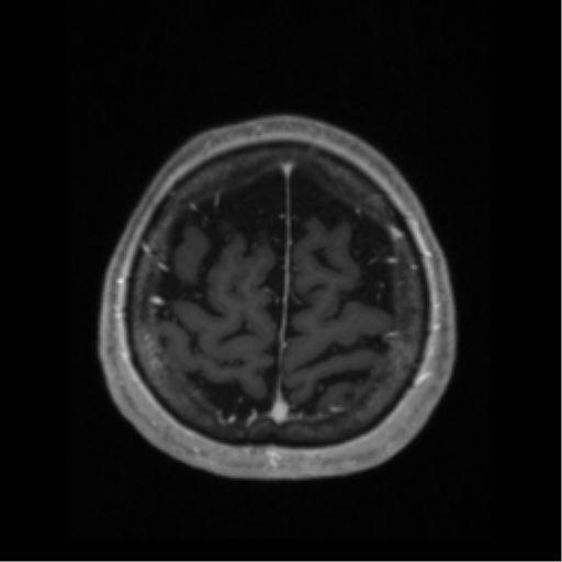 File:Anaplastic astrocytoma IDH wild-type (pseudoprogression) (Radiopaedia 42209-45276 Axial T1 C+ 126).png