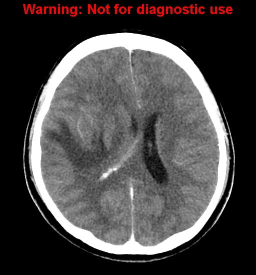 File:Anaplastic ganglioglioma (Radiopaedia 44921-48815 B 18).jpg