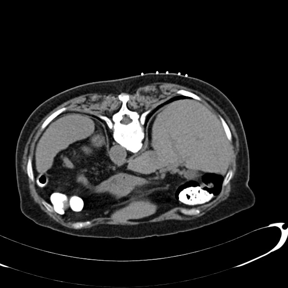 File:Anaplastic lymphoma - with CT biopsy (Radiopaedia 21643-21602 Axial non-contrast 3).jpg